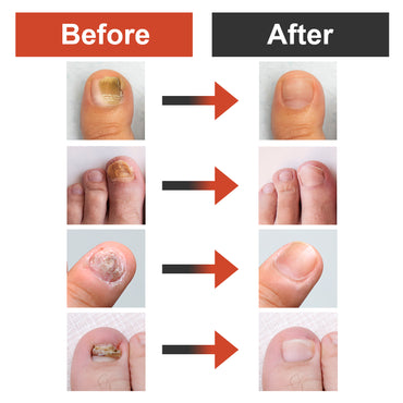 Severe Fungal Nail Treatment